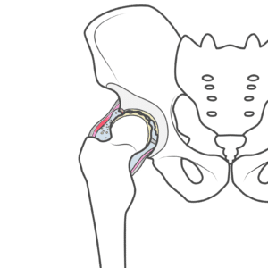 【金町の整体】子どもの頃、ペルテス病を経験した方が、大人になって変形性股関節症や股関節痛を発症。整体で手術を回避できます！