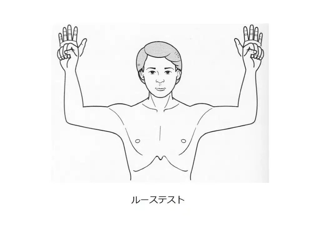 胸郭出口症候群