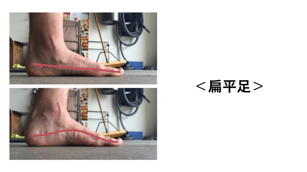 【葛飾区金町のやぎはし整体院】ひざの痛みの治療・整体　扁平足を治すことで膝の痛みを劇的に改善！