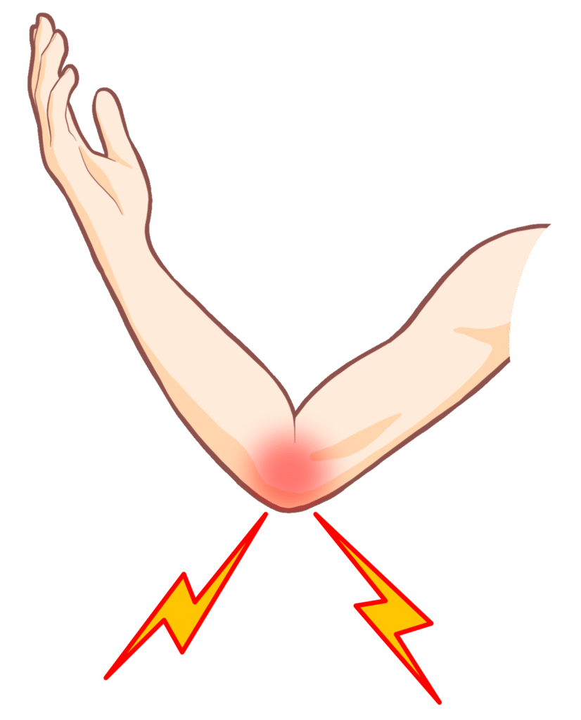 ゴルフ肘(上腕骨内側上顆炎)