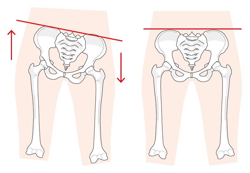 骨盤のゆがみ