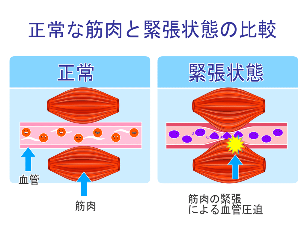 筋肉の硬さとストレートネック