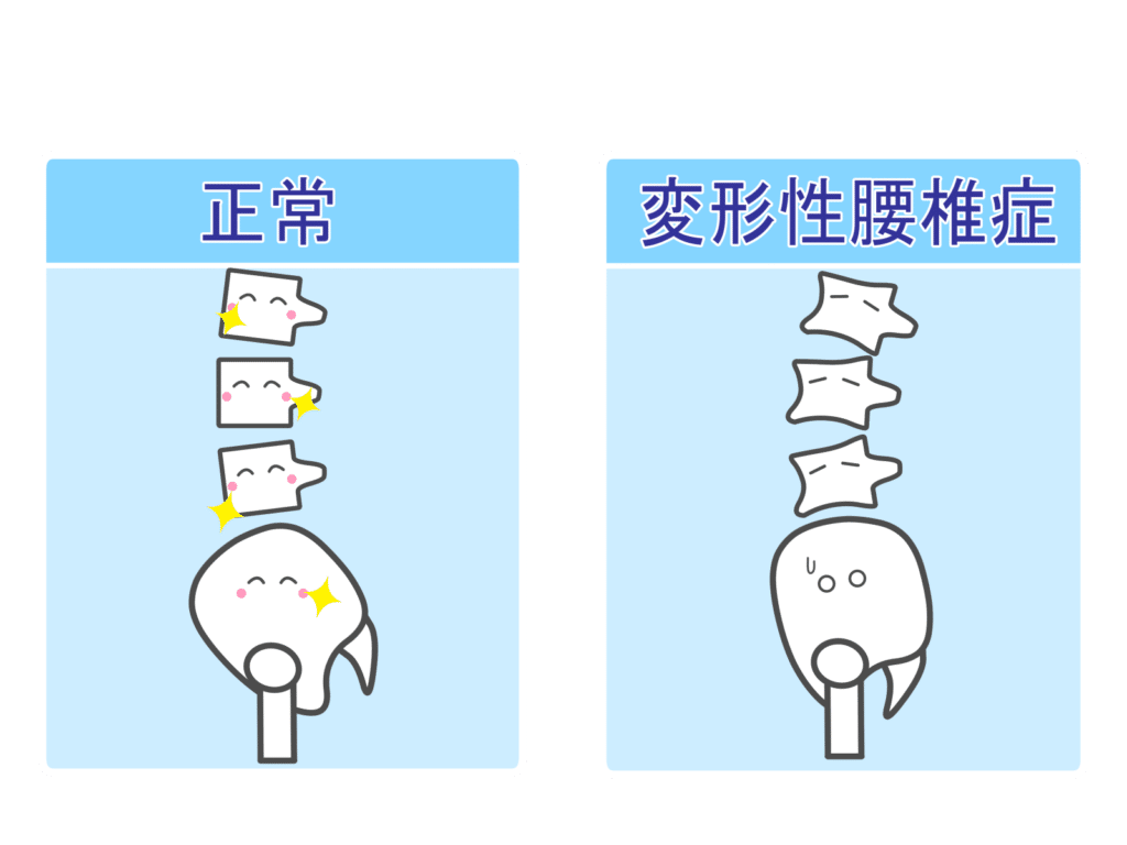 背骨の歪みとストレートネック