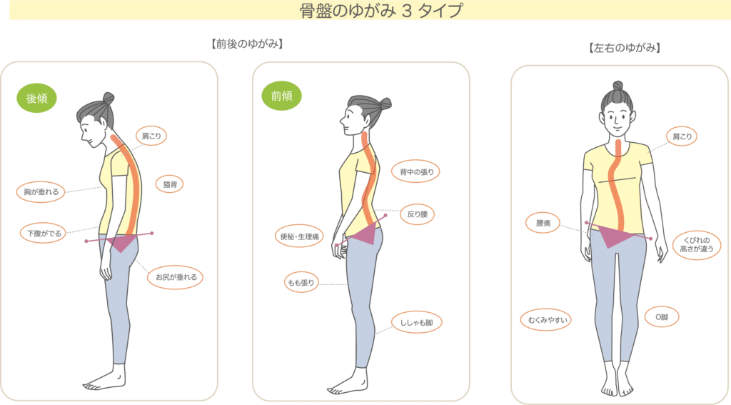 骨盤歪みとストレートネック