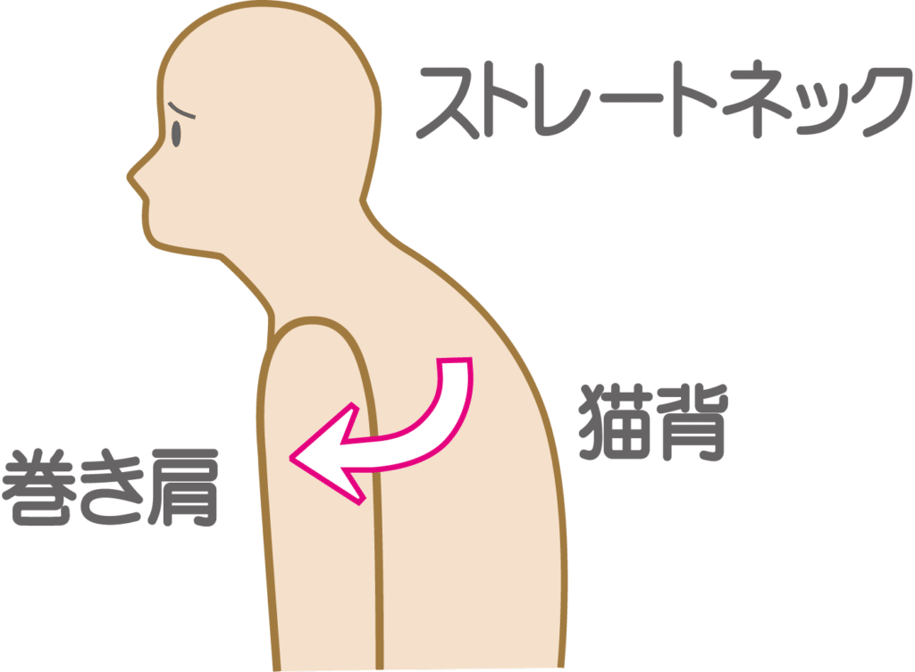 猫背とストレートネック