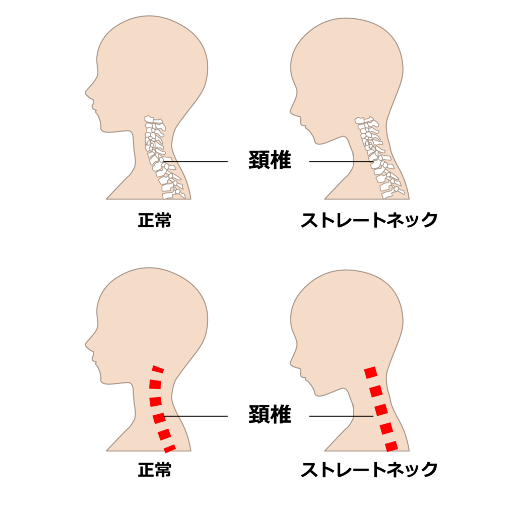 ストレートネック