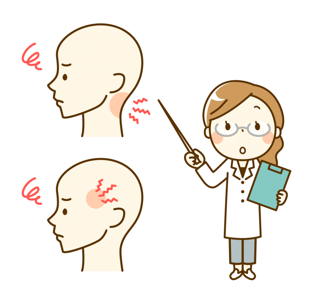 後頭神経痛の説明イラスト