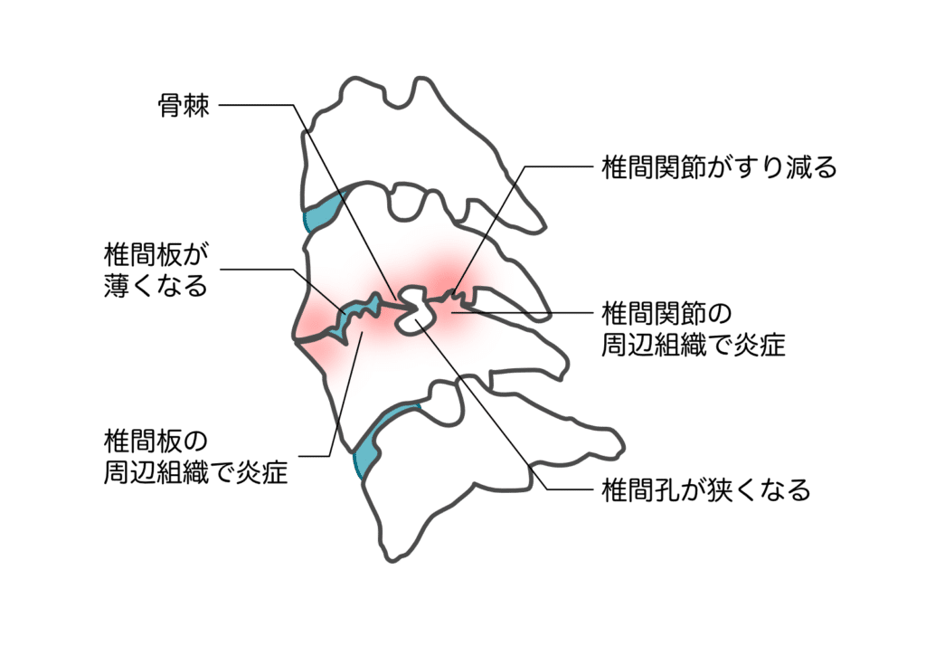 関節のズレとストレートネック