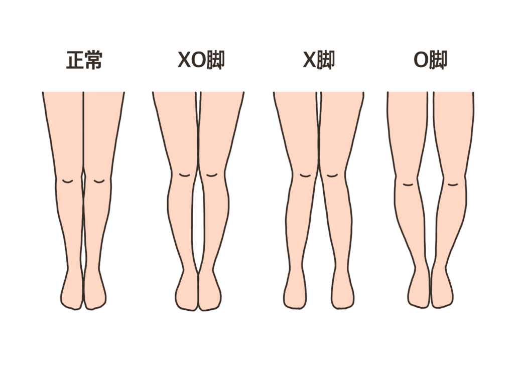 O脚とストレートネック