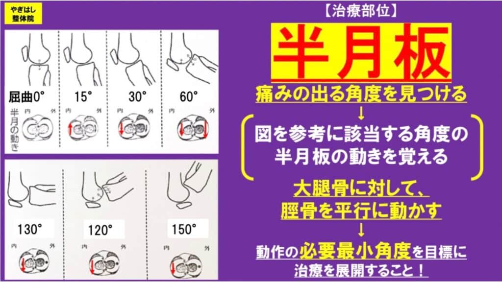 膝の痛み：半月板の治療