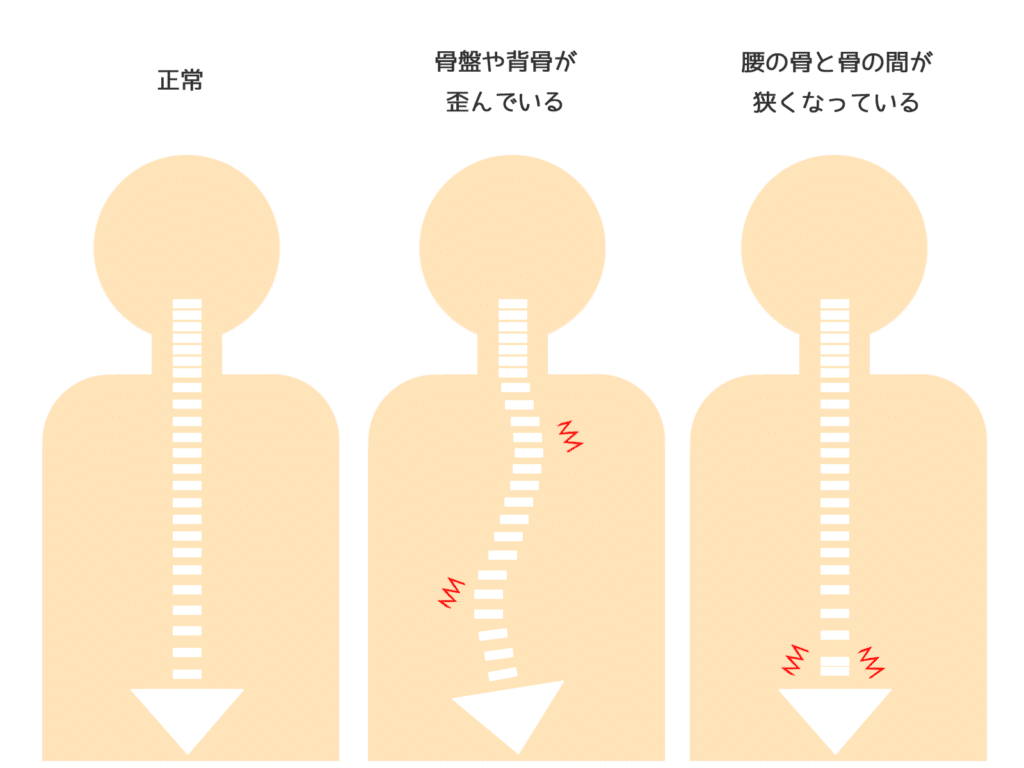 側弯症の型