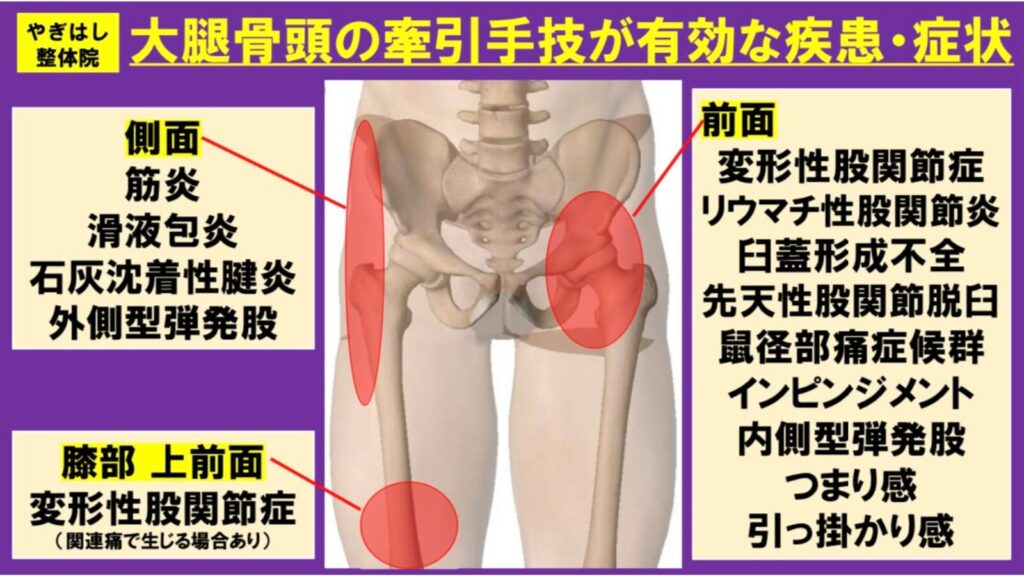 大腿骨頭の詰まりを解消する