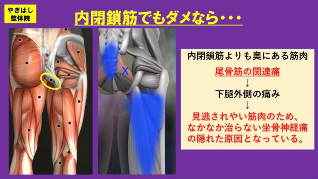 坐骨神経痛の治療3