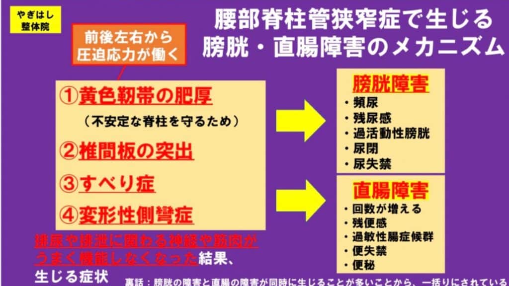 脊柱管狭窄症：排便排尿障害2