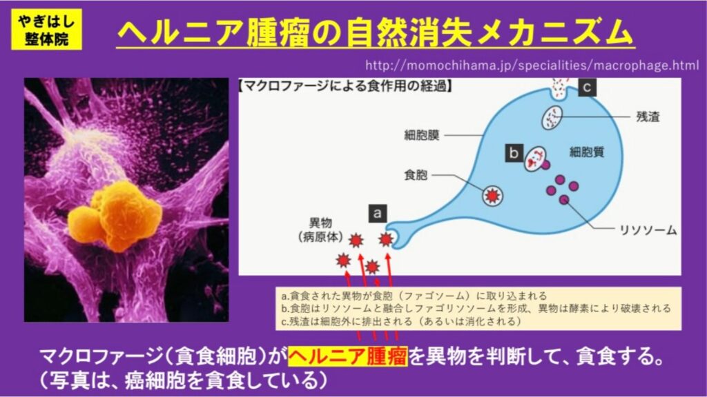 ヘルニアの自然消滅３