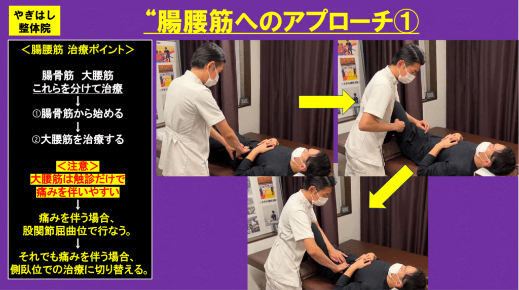 腸骨筋アプローチ3