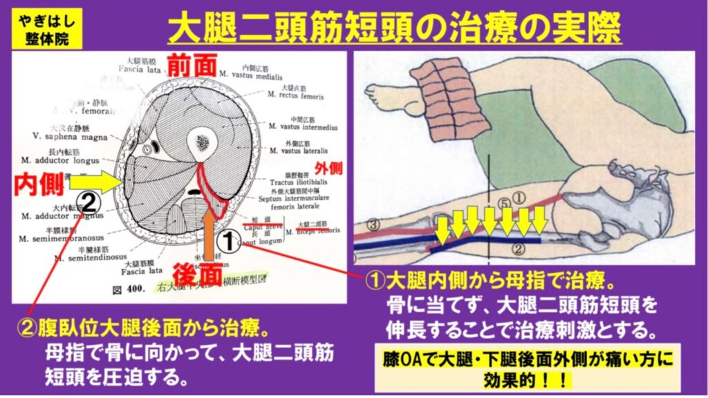 膝の痛み：大腿二頭筋３