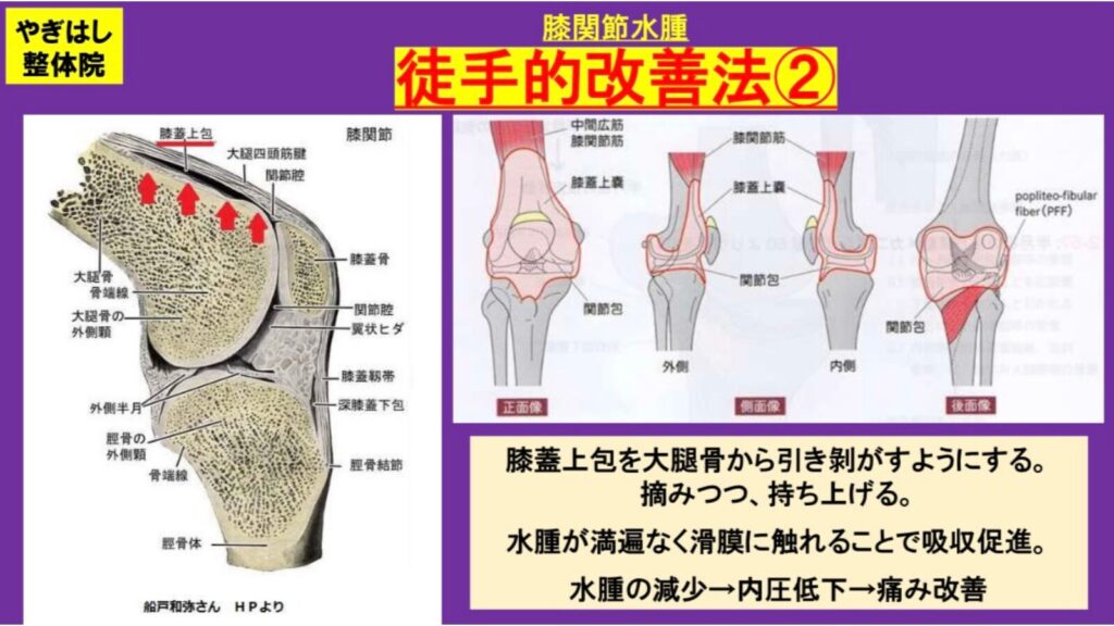 お膝の水を抜く治療