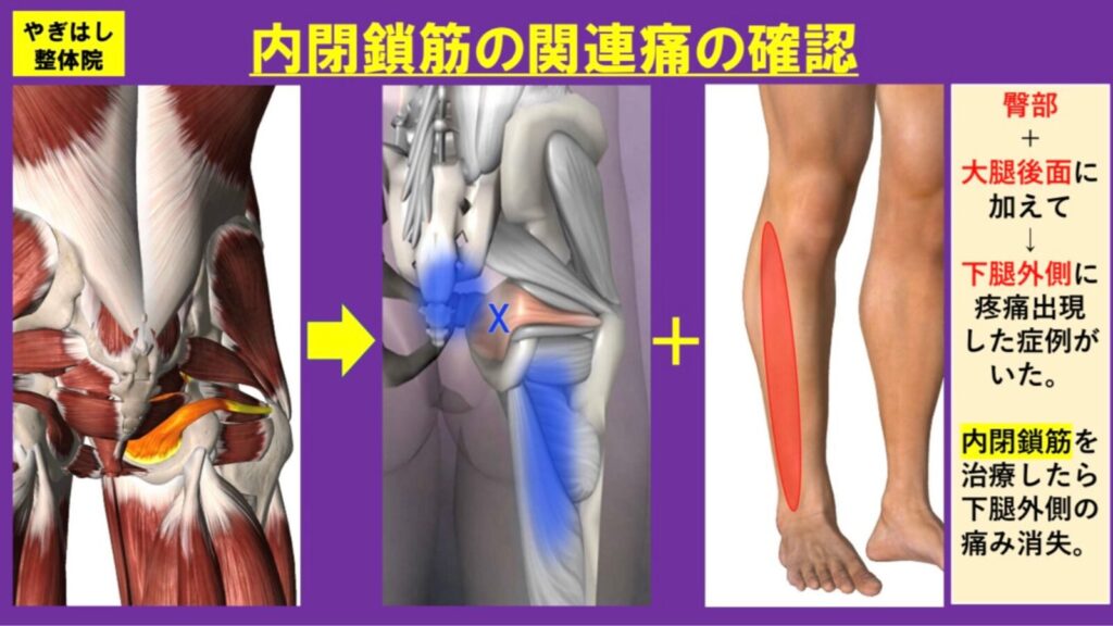 坐骨神経痛の治療2