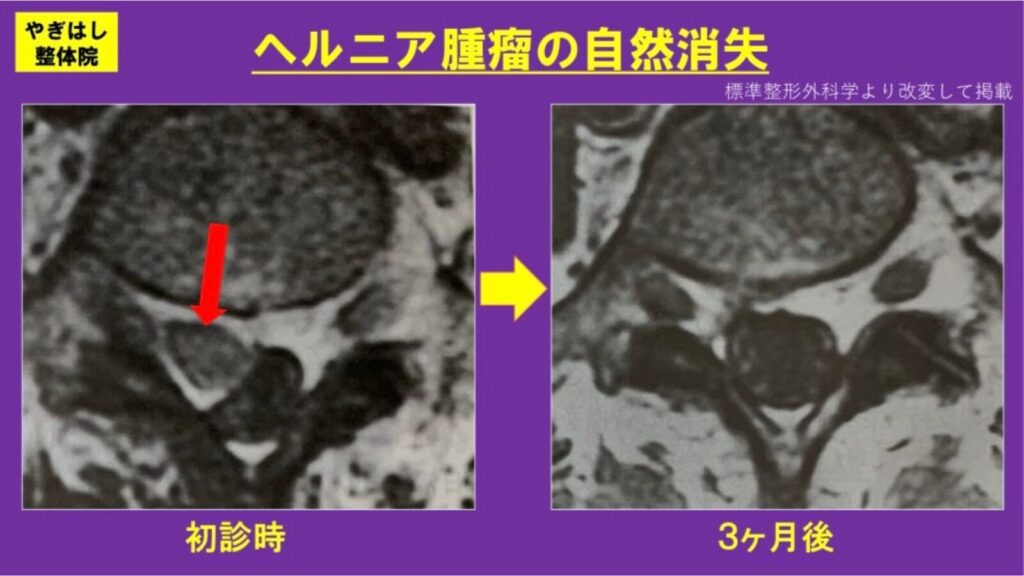ヘルニアの自然諸滅２