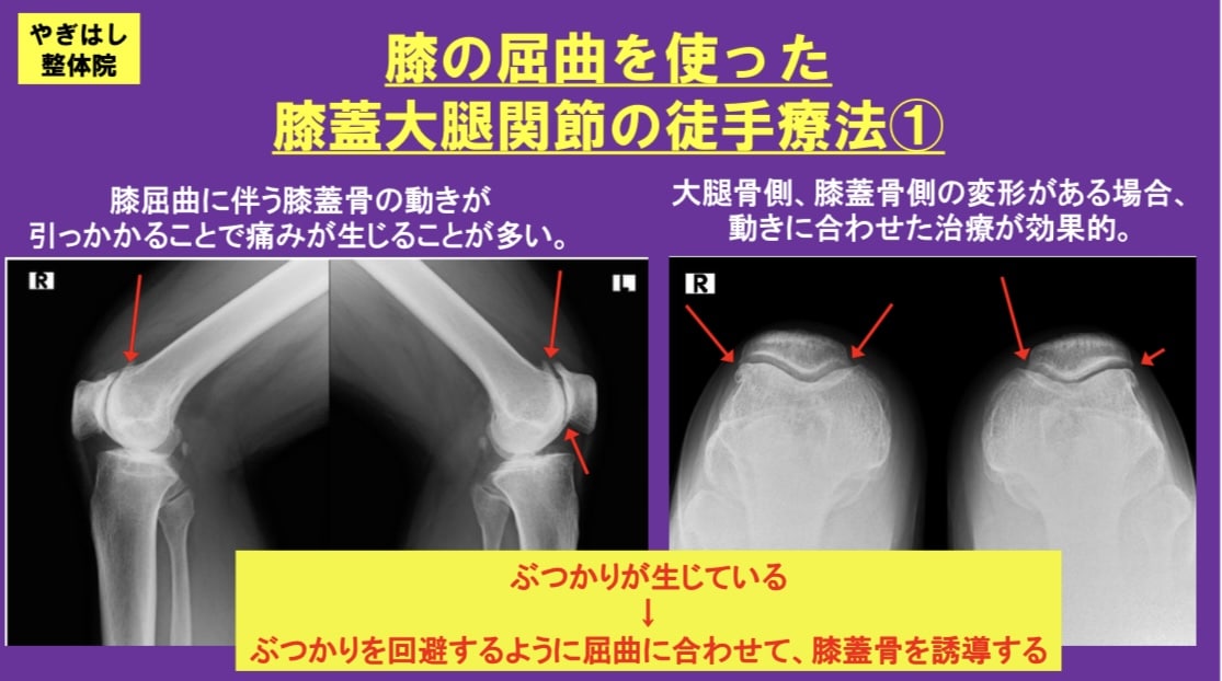 お膝の皿の治療