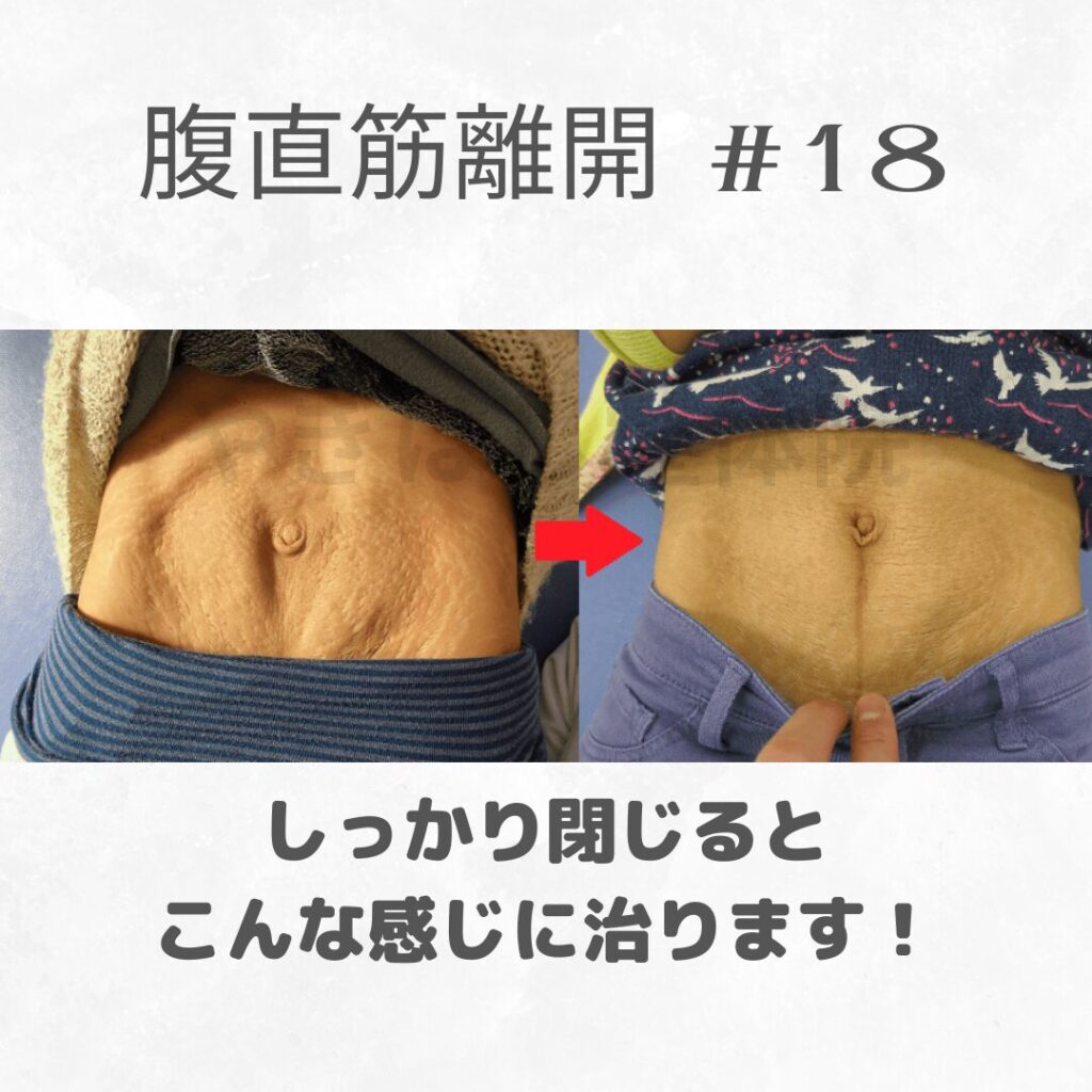 腹直筋離開の改善