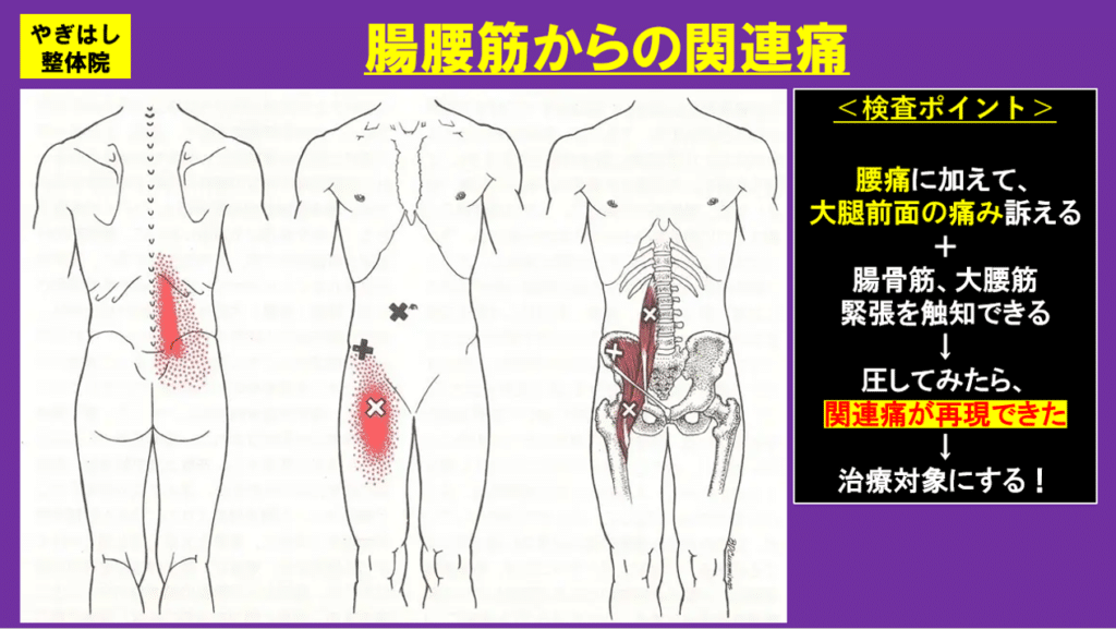 腸骨筋アプローチ2