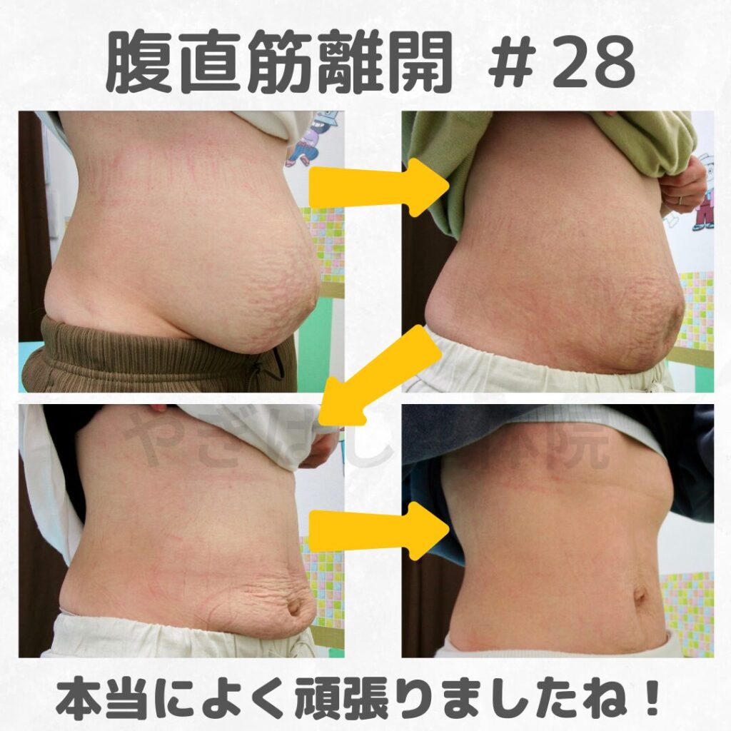 腹直筋離開の改善①