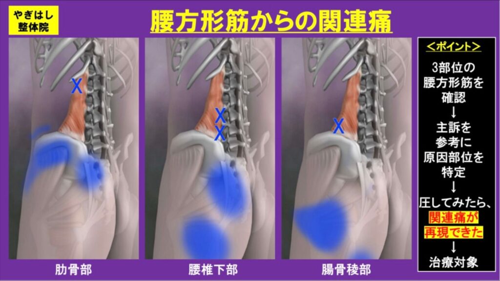 腰方形筋の治療
